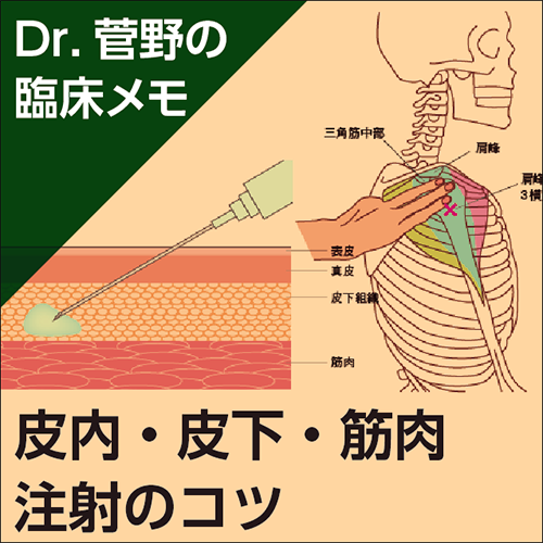 皮内 皮下 筋肉注射のコツ Dr 菅野の臨床メモ 電子コンテンツ 日本