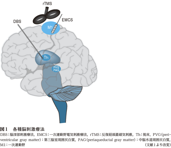 3）難治性疼痛に対する脳刺激療法 ［特集：脳刺激療法で治療できる症状