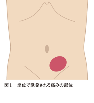 座ると出現する左下腹部痛を訴えた56歳男性 キーフレーズで読み解く 外来診断学 128 Web医事新報 日本医事新報社