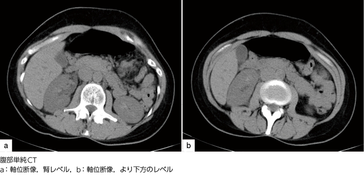 右背部痛の原因は何か 画像診断道場 実はこうだった 55 Web医事新報 日本医事新報社