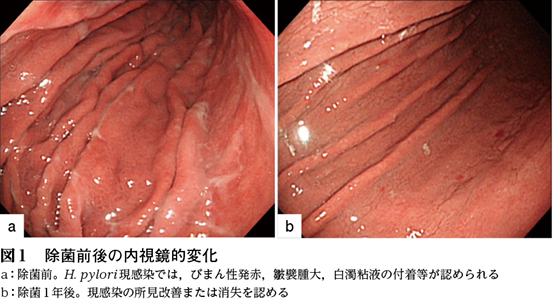 ピロリ 菌 除去 後