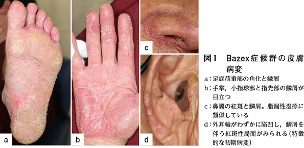 悪性 腫瘍