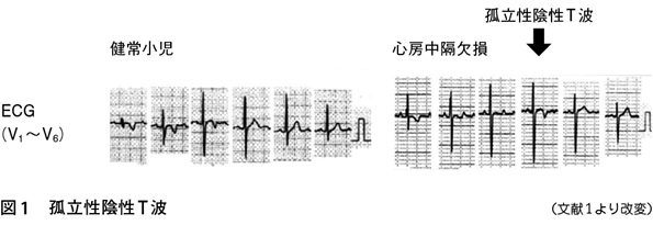 T 心電図 陰性