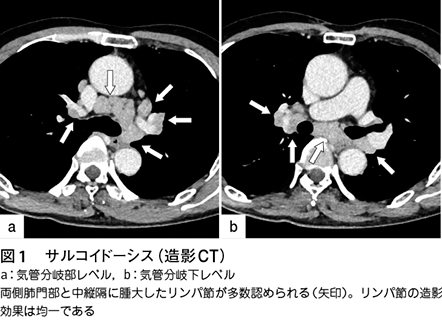 3）中・後縦隔に生じやすい病変［特集：縦隔腫瘍 診断の進め方］｜Web