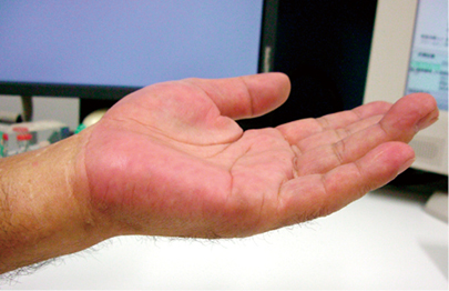痒い 手のひら が 手のひらがかゆいのは病気？考えられる８つの原因と対処方法を知ろう！
