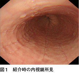 逆流性食道炎 口臭 薬