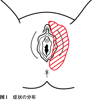 左外陰部の違和感を訴える60歳女性 キーフレーズで読み解く 外来診断学 177 Web医事新報 日本医事新報社