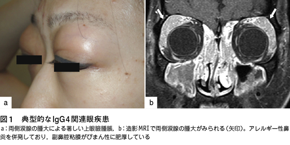 2 Igg4関連眼疾患の診断と治療 特集 唾液腺 眼病変からみたigg4関連疾患の進歩 Web医事新報 日本医事新報社