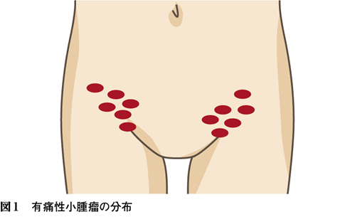 繰り返す両側鼠径部の有痛性腫脹を訴える18歳女性 キーフレーズで読み解く 外来診断学 199 Web医事新報 日本医事新報社