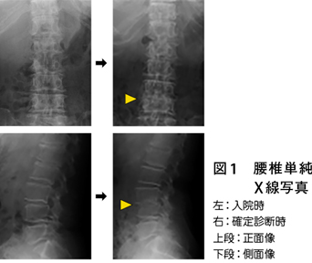 化膿 性 脊椎 炎