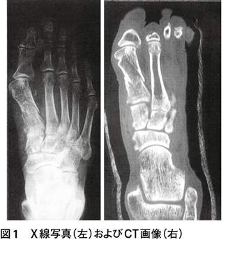 骨折 粉砕 開放 性