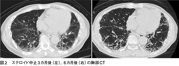 副作用によりステロイド継続困難な特発性間質性肺炎 難渋症例から学ぶ診療のエッセンス 57 Web医事新報 日本医事新報社