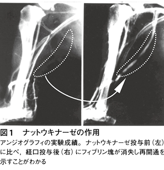 ナットウキナーゼによる動脈硬化症予防 ｜Web医事新報|日本医事新報社