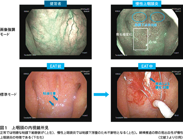 慢性上咽頭炎 漢方