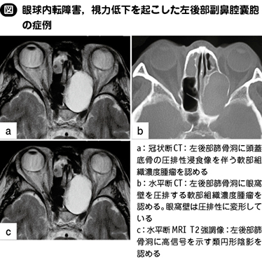 炎症 眼窩 特発 性 特発性眼窩炎症(眼窩炎症性偽腫瘍)のMRI画像診断(眼窩腫瘍の鑑別)