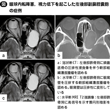 副鼻腔囊胞 私の治療 Web医事新報 日本医事新報社