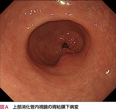 胃粘膜下腫瘍……それとも？［画像診断道場～実はこうだった（158