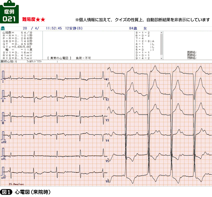 高血圧でふらつきを認める症例でも帰宅させずに心電図をとる すきドリ すき間ドリル 心電図 ヒロへの挑戦状 21 Web医事新報 日本医事新報社 高血圧でふらつきを認める症例でも帰宅させずに心電図をとる すきドリ すき間ドリル 心電図 ヒロへの挑戦状 21 Web医事新報 日本医事新報社