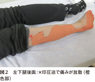 左下腿の脱力と痛みを主訴に受診した75歳女性 キーフレーズで読み解く 外来診断学 224 Web医事新報 日本医事新報社