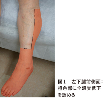 左下腿の脱力と痛みを主訴に受診した75歳女性 キーフレーズで読み解く 外来診断学 224 Web医事新報 日本医事新報社