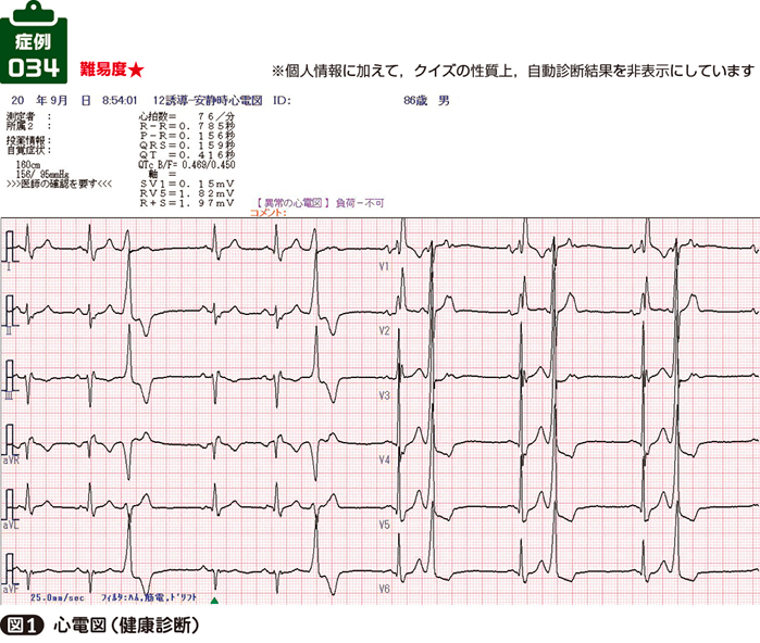 異常波形の読み方 心電図鑑別のチェックポイント 健康 | www.vinoflix.com