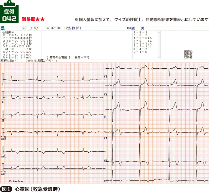 心房頻拍 なのに 徐脈 疑われた脳卒中はフェイクだった すきドリ すき間ドリル 心電図 ヒロへの挑戦状 42 Web医事新報 日本医事新報社