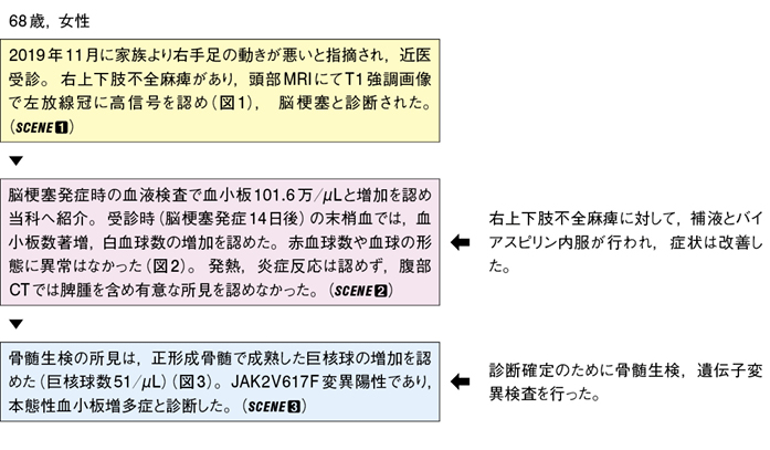 脳梗塞発症時にみられた血小板数増多［難渋症例から学ぶ診療のエッセンス（114）］｜Web医事新報|日本医事新報社