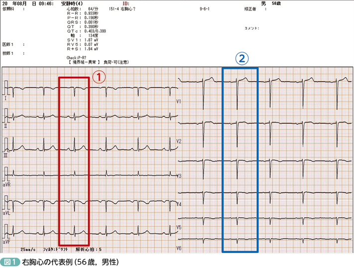 右 胸 心 心電図 の 取り 方