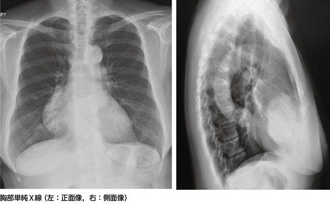 胸部単純X線で心臓右縁第2弓に腫瘍影，肺癌？ 縦隔腫瘍？［画像診断