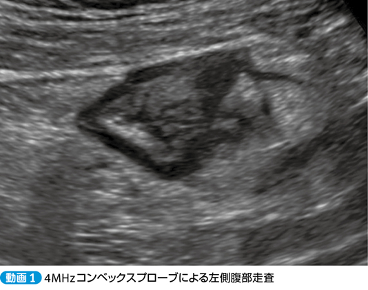 左下腹部痛を訴える52歳男性[消化管エコー動画読影トレーニング10