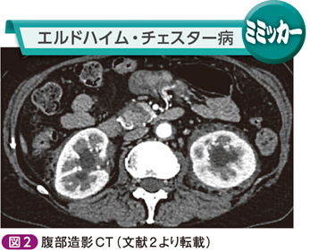 特発性後腹膜線維症［もう騙されない！外来に現れるミミック疾患