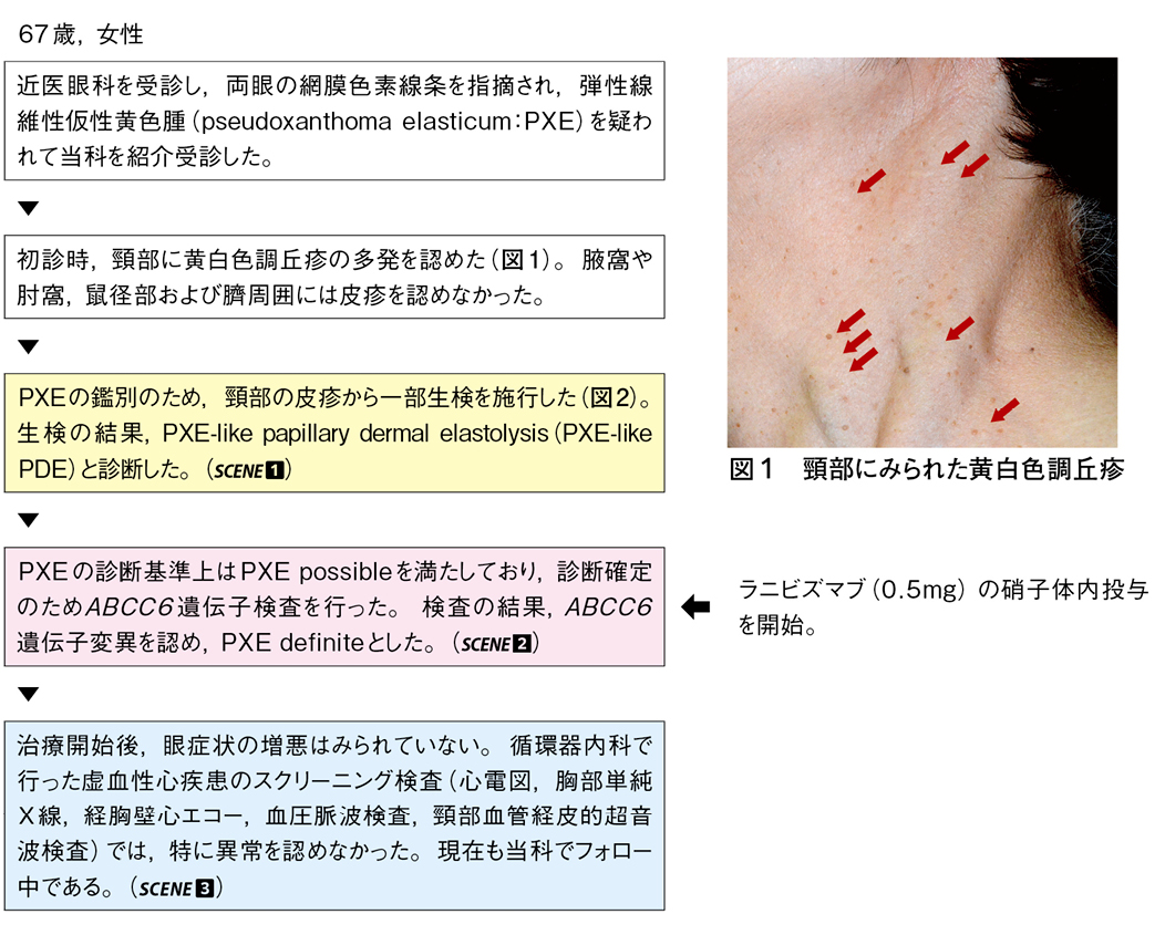 PXE患者にみられたPXE-like papillary dermal elastolysis［難渋