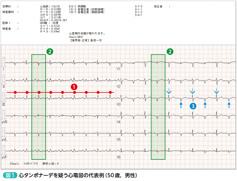 楽天ブックス: 徹底解説！心電図 - 基礎から臨床まで - 森博愛